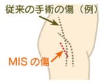 最小侵襲手術（MIS）