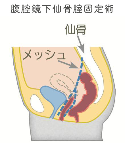 腹腔鏡下仙骨腟固定術