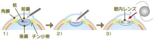 白内障手術の流れ