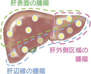 腹腔鏡下手術