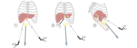 腹腔鏡下肝切除術の手技