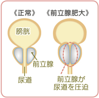 前立腺肥大症