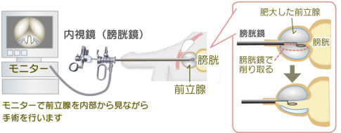 内視鏡（膀胱鏡）手術