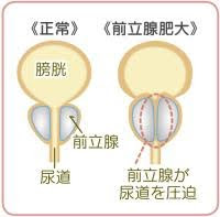 前立腺肥大症