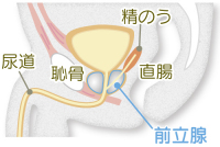 前立腺がん