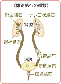 尿路結石