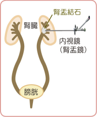 内視鏡（腎盂鏡）手術（尿管鏡）手術