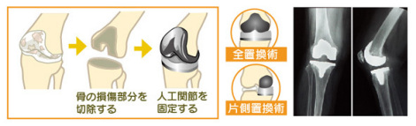 人工膝関節置換術