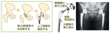 人工股関節置換術