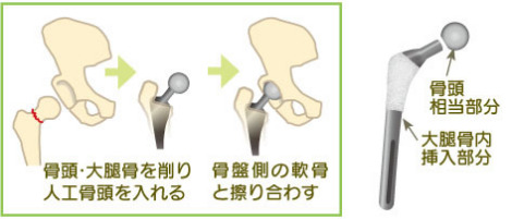 人工骨頭置換術について