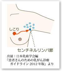 センチネルリンパ節