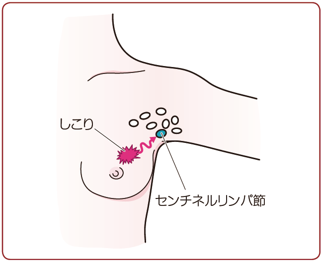 がん治療の3本柱