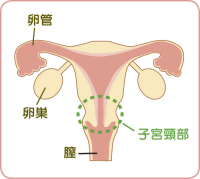 子宮頸がん