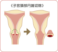 子宮頚部円錐切除