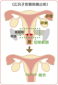 広汎子宮頸部摘出術