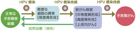 子宮頸がんの原因