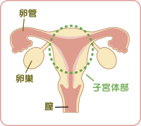 子宮体がん治療