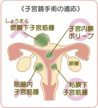 子宮鏡手術の適応