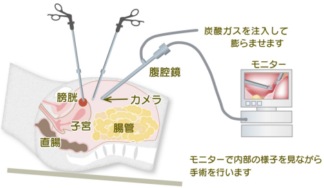 腹腔鏡下手術とは