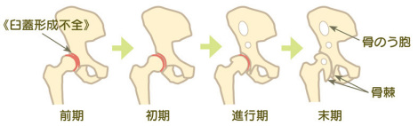 変形性股関節症の進行