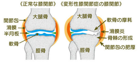 変形性膝関節症