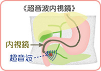 超音波内視鏡のイラスト