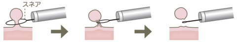 ポリペクトミーの施術イメージイラスト