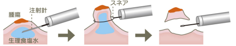 内視鏡的粘膜切除術（EMR）の施術イメージイラスト