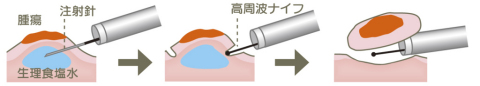 内視鏡的粘膜下層剥離術（ESD）施術イメージイラスト