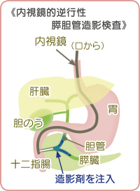 内視鏡的逆行性膵胆管造影検査