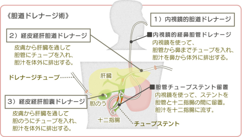 肝胆道イミノ二酢酸 (HIDA) スキャンについてはどうですか?