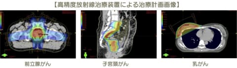 高精度放射線治療装置による治療計画画像