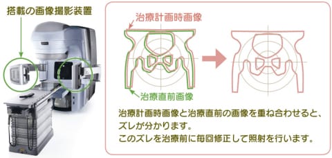 画像誘導放射線治療