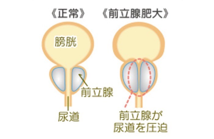 「前立腺肥大症」について の画像